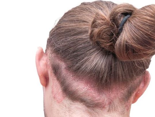 Skuteczne kosmetyki na łuszczycę Skuteczne kosmetyki na łuszczycę